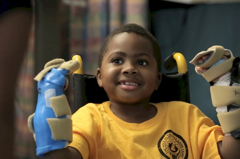 全球首例兒童雙手移植 手術1年半後能寫字