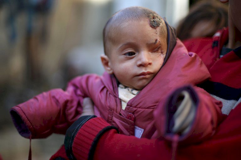 敘利亞男嬰獨眼照引關懷 成內戰象徵
