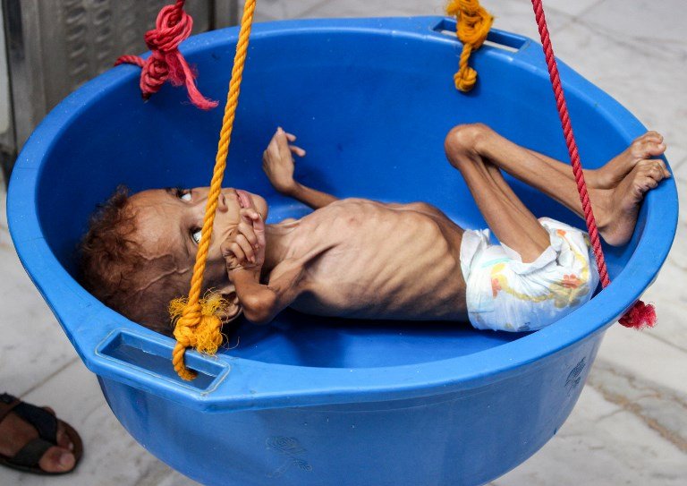 虛弱到哭不出來 葉門8.5萬兒童死於饑餓與疾病