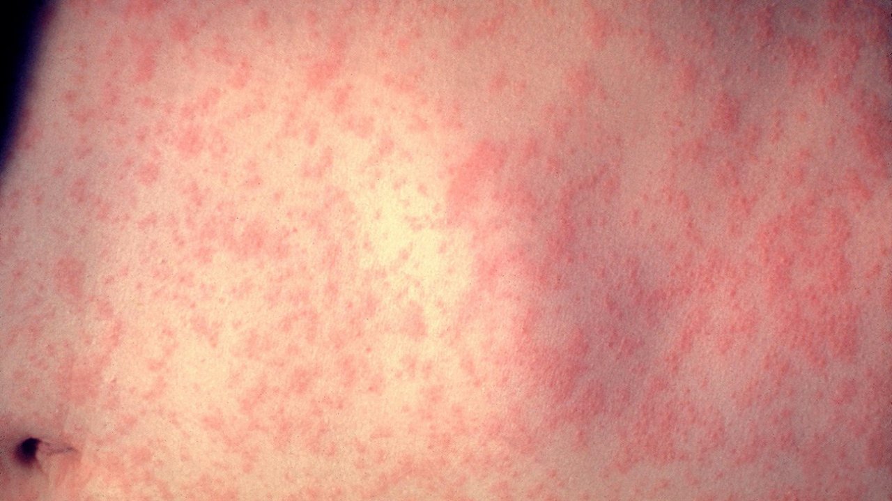 南韓麻疹疫情延燒 38確定病例