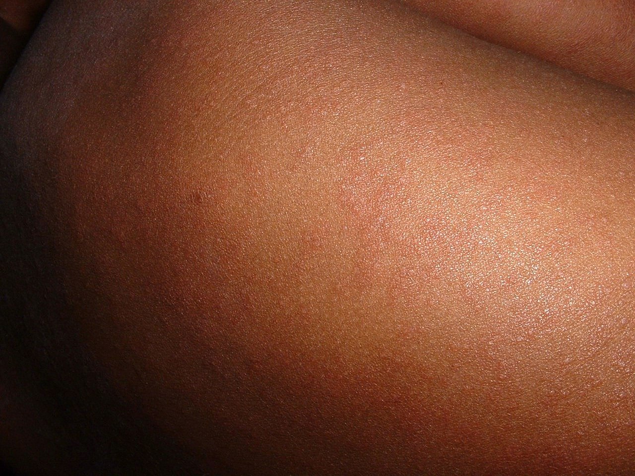 美麻疹疫情降溫 1月來首週未傳新增病例