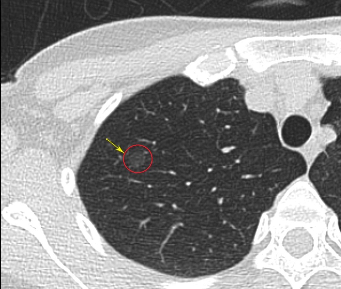 肺癌無痛無感難發現 靠低劑量電腦斷層揪出病灶