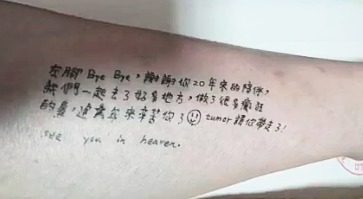清大生患骨肉癌 截肢前在左腿寫上「謝謝20年來的陪伴」