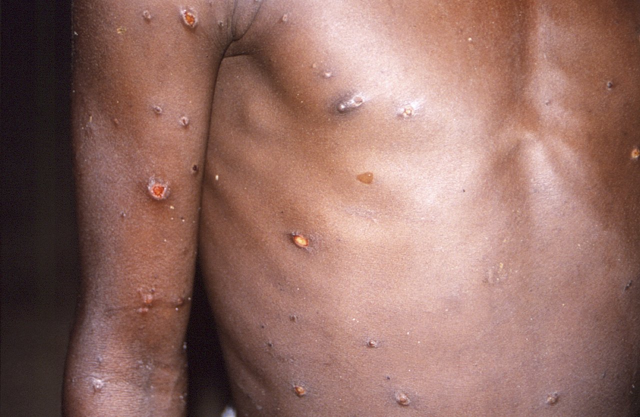 WHO：猴痘不太可能造成全球大流行