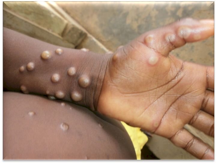 恐重蹈COVID覆轍 專家籲對猴痘採取更快行動