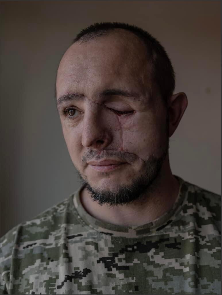 治癒烏克蘭士兵 顏面重建與馬術的身心修補