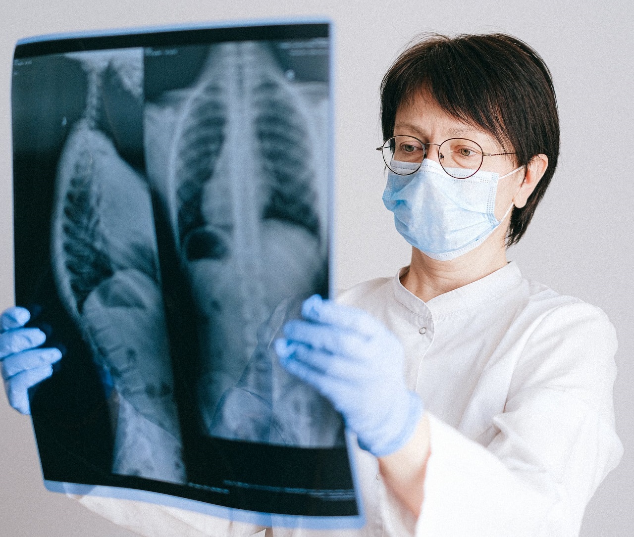 肺癌篩檢上路1年半揪出近千名確診 早期個案占85%